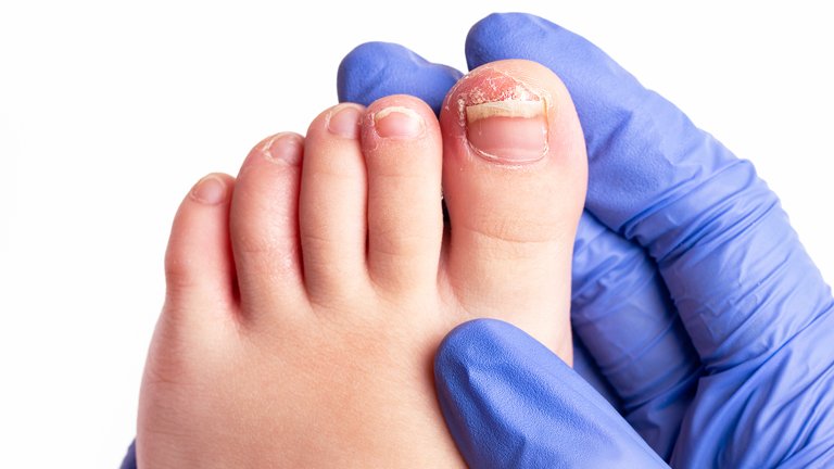 Enfermedades de las uñas