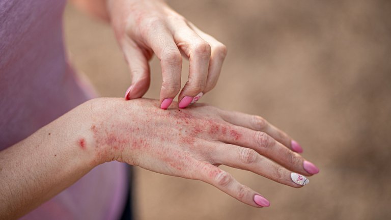 Dermatitis - Urticaria - Psoriasis