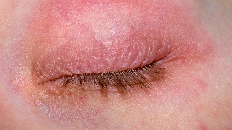 Dermatitis atópica