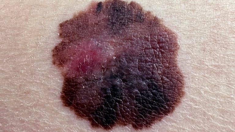 Carcinoma - Melanoma - Oncología cutánea