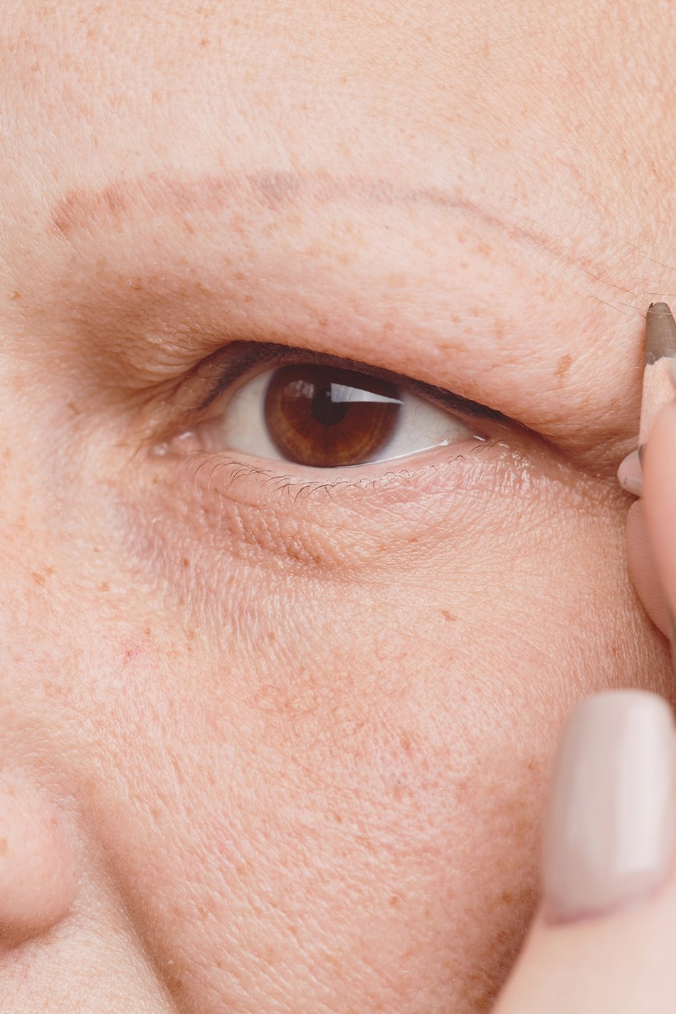 Alopecia en cejas y pestañas