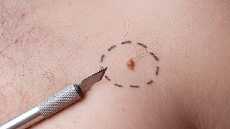 Patologia oncologica