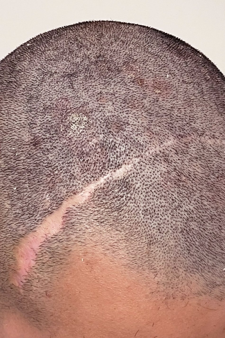 Cicatrices post quirúrgicas - accidentes Cicatrices post quirúrgicas - accidentes