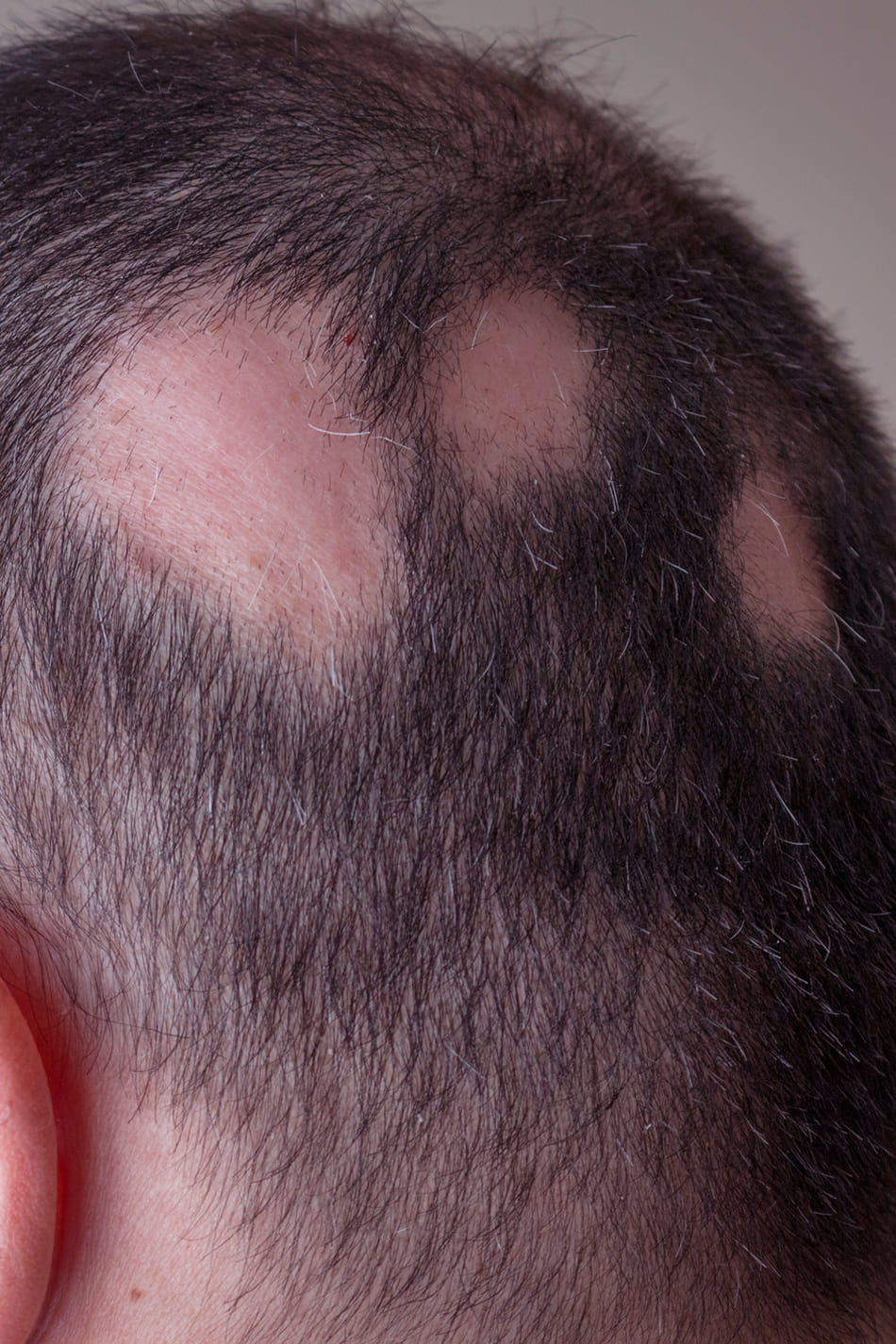 Alopecia areata en el cuero cabelludo con pérdida de cabello en placas — patología capilar tratada por dermatología especializada