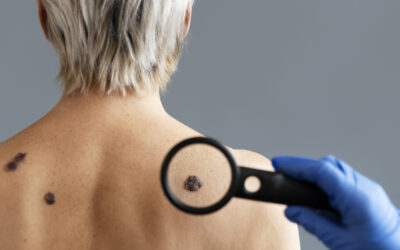 ¿Por qué es importante revisar tus lunares en una clínica dermatológica especializada?