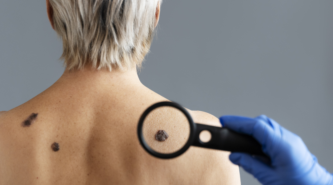Dermatóloga revisando lunares en la piel de un paciente en clínica especializada