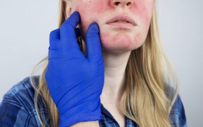 Cómo saber si tenés rosácea y cuáles son los tratamientos más efectivos