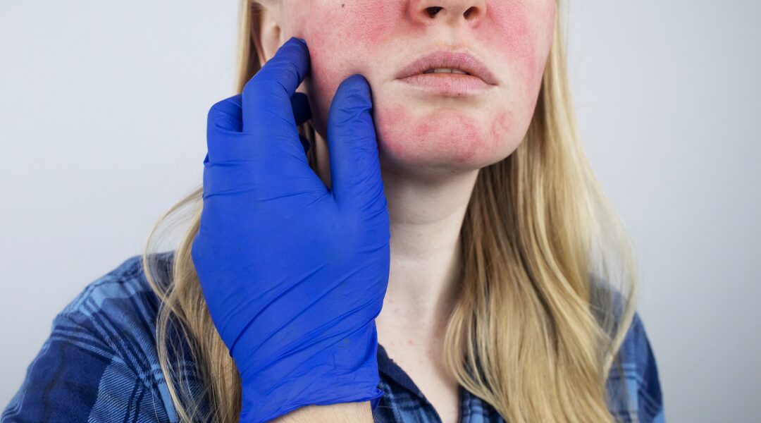 Tratamiento para rosácea en Experiencia Piel con enfoque dermatológico y facial