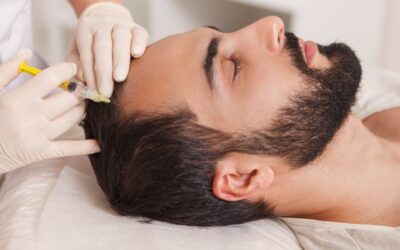 Implante capilar y tratamiento de la caída de cabello: lo que necesitás saber